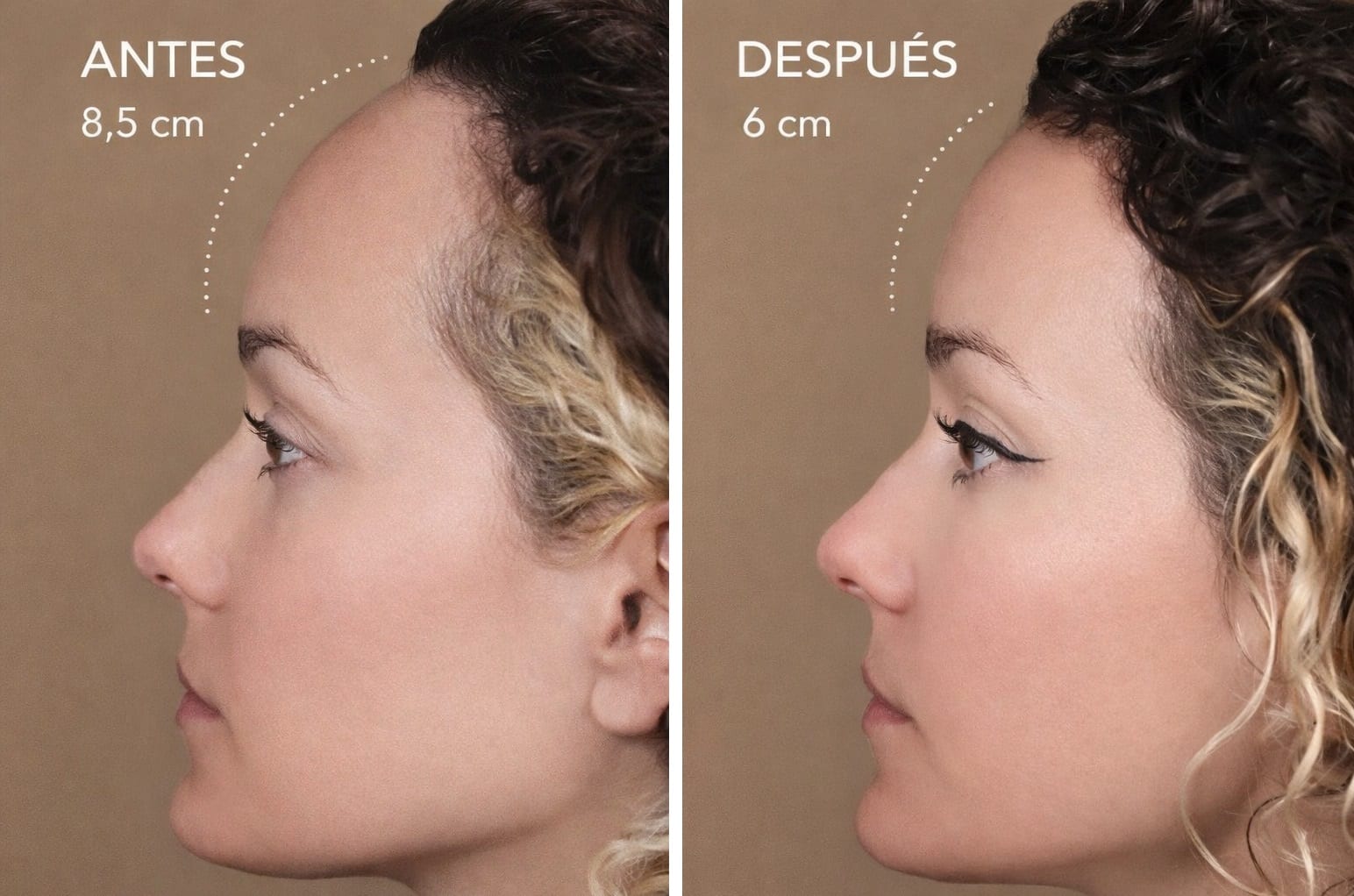 Frontoplastia Endoscópica caso 1 — antes y después